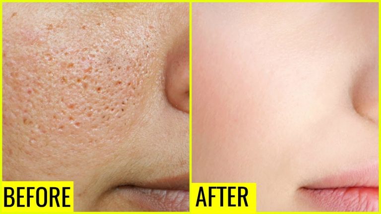 3 Days and All Open Pores Will Disappear from Your Skin Permanently