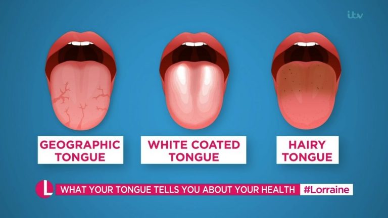 What Your Tongue Can Tell You About Your Health