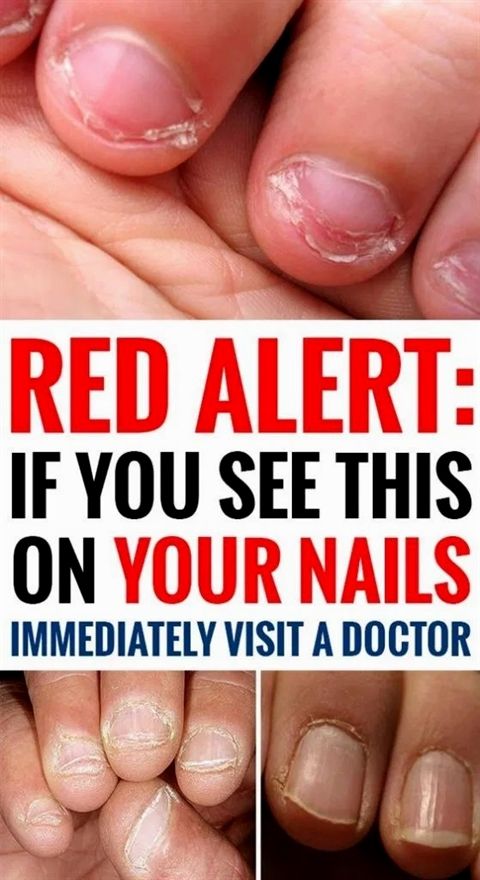 Red Alert: If You See This On Your Nails Immediately Visit A Doctor!