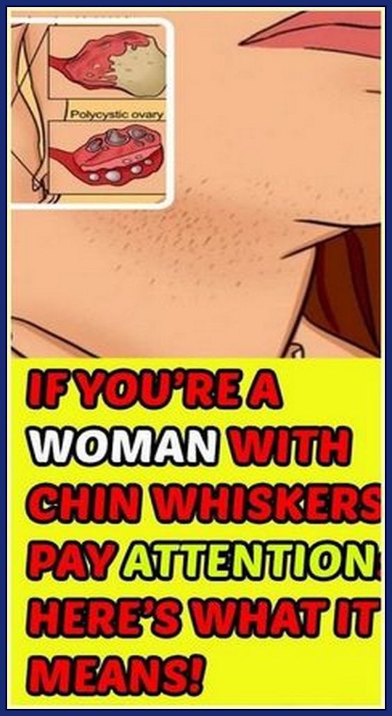 IF YOU’RE A WOMAN WITH CHIN WHISKERS, PAY ATTENTION. HERE’S WHAT IT MEANS!